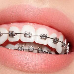 dentista en villa el salvador - ortodoncia